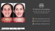 نمونه درمان ارتودنسی شفاف یا نامرئی (invisible orthodontics)