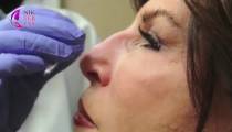 آموزش تزریق ژل بینی