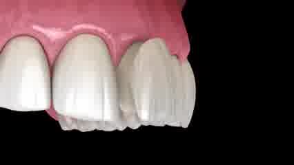 مراحل لمینت دندان