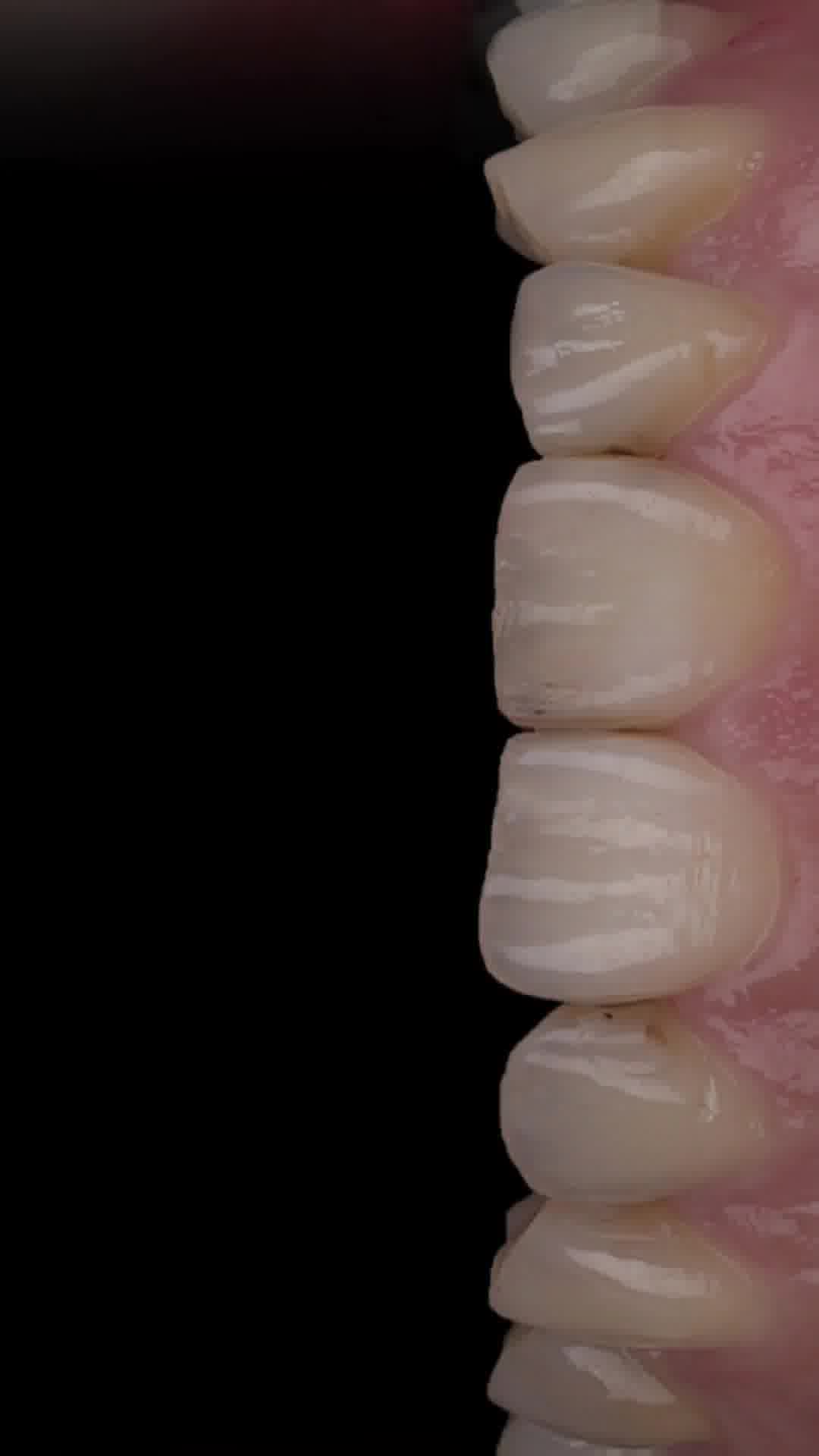 با لمینت و کامپوزیت دندان بیشتر بخندید!