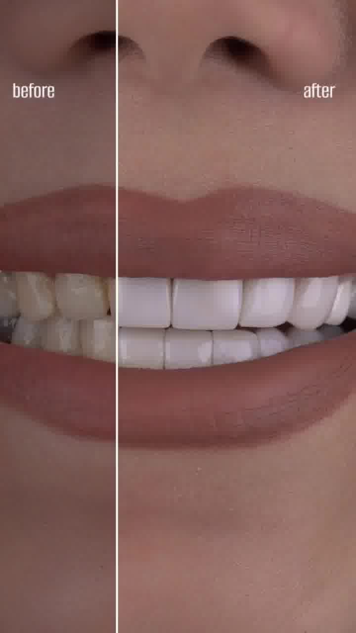 قبل و بعد از کامپوزیت دندان