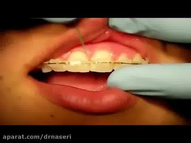 نحوه استفاده از عبور دهنده نخ دندان ارتودنسی
