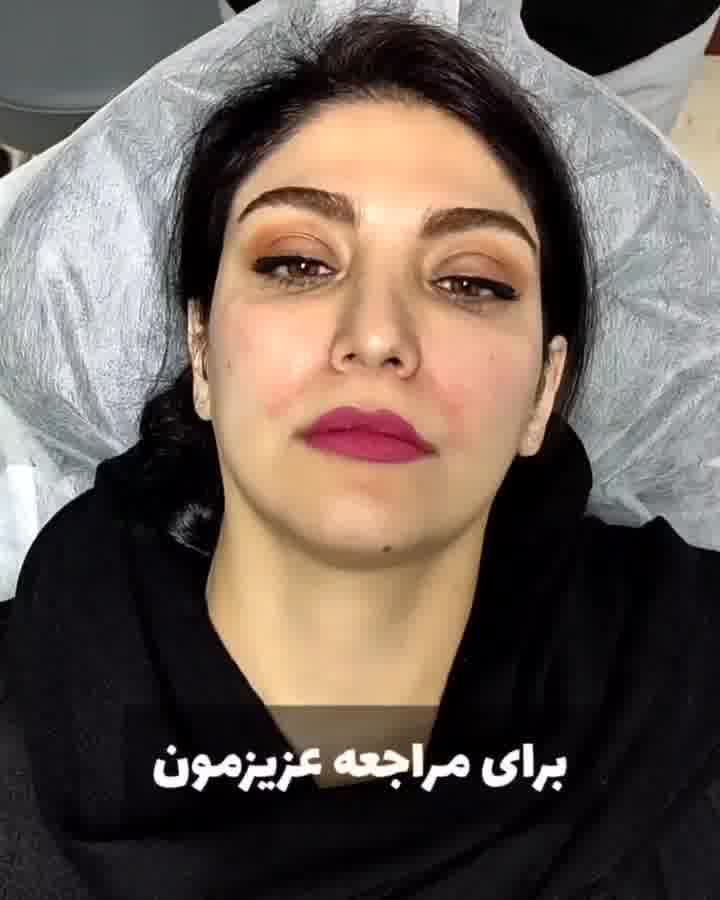 کاشت موی سبیل با روش  FUE توسط دکتر دلیر