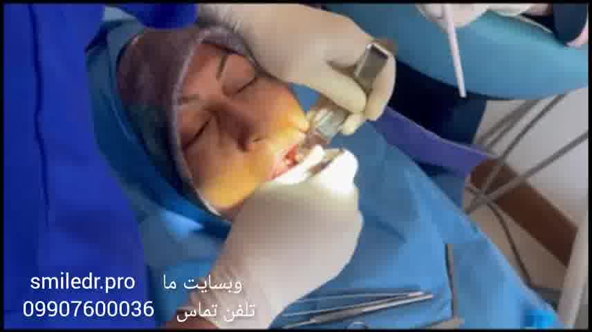 فیلم کاشت جراحی ایمپلنت  با یرند سوییسی